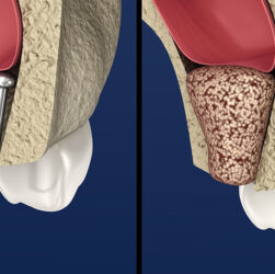 Alternatives To Bone Grafting You Can Try