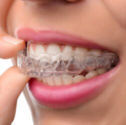 What to Expect from the Invisalign Process