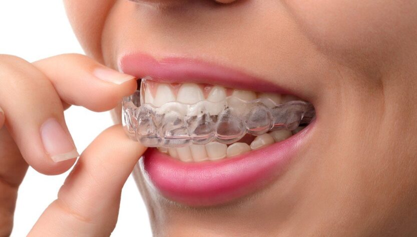 What to Expect from the Invisalign Process